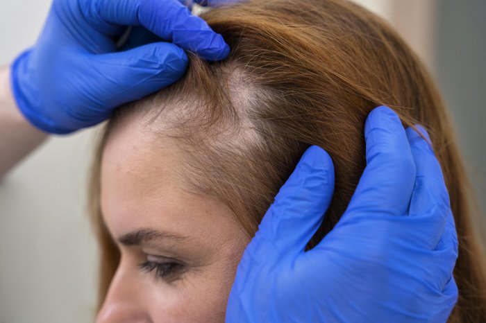 Пересадка волос для женщин методом FUE смотреть