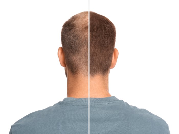 Пересадка волос для мужчин методом FUE смотреть