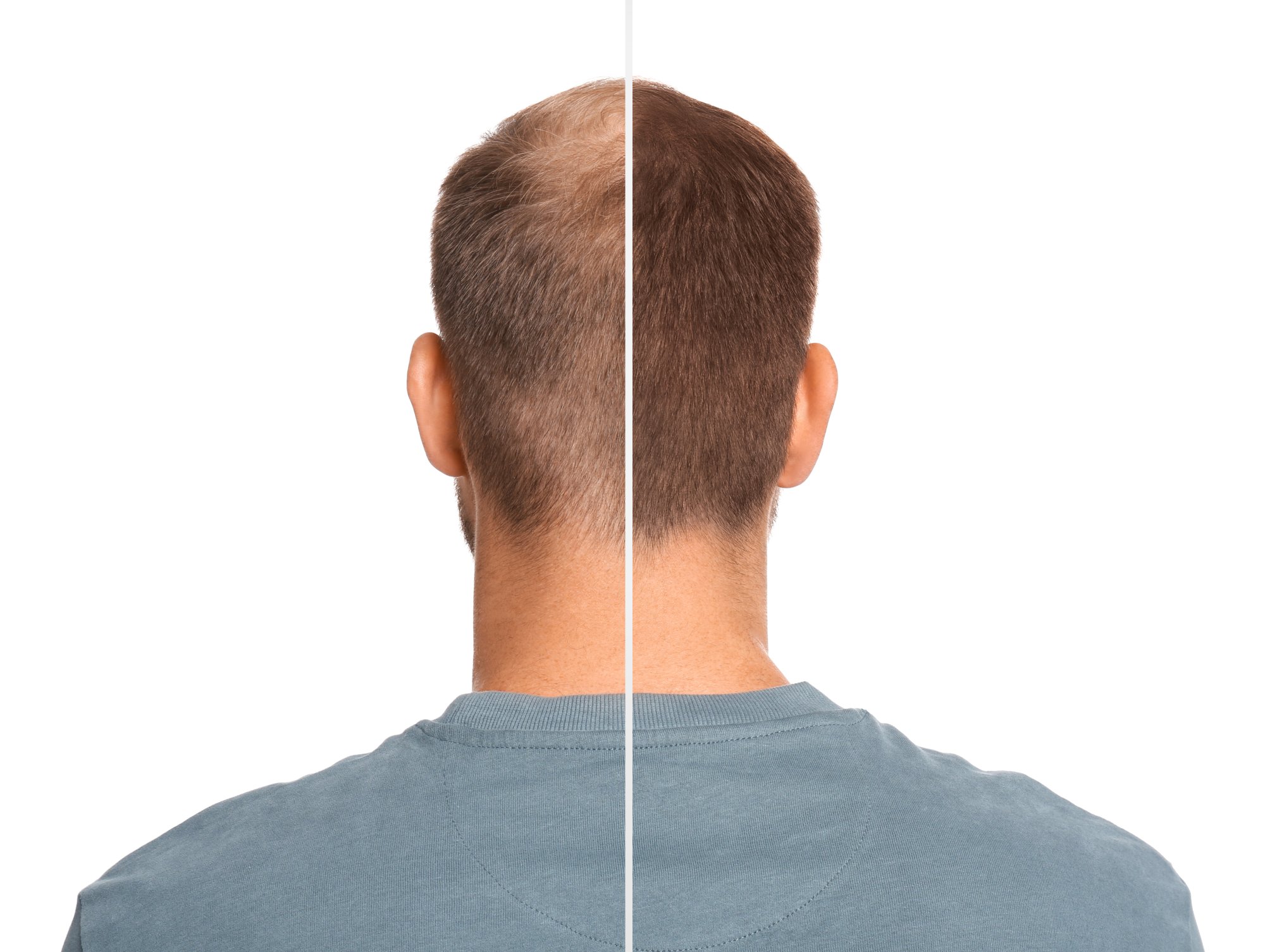 Пересадка волос для мужчин методом FUE